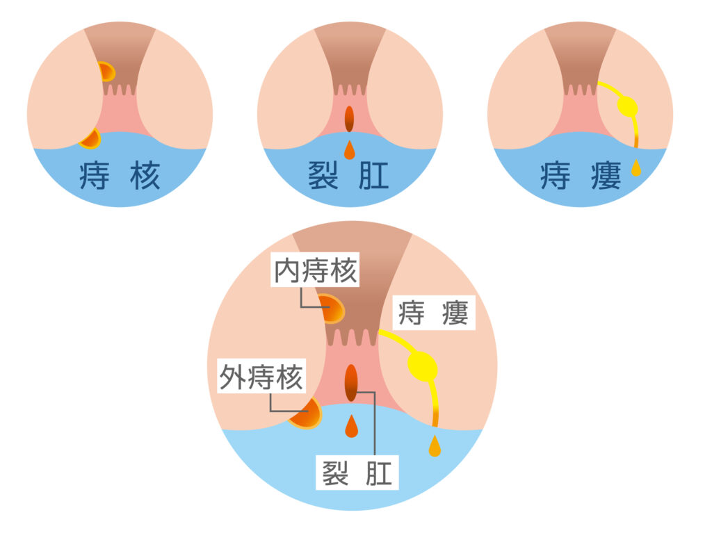 痔